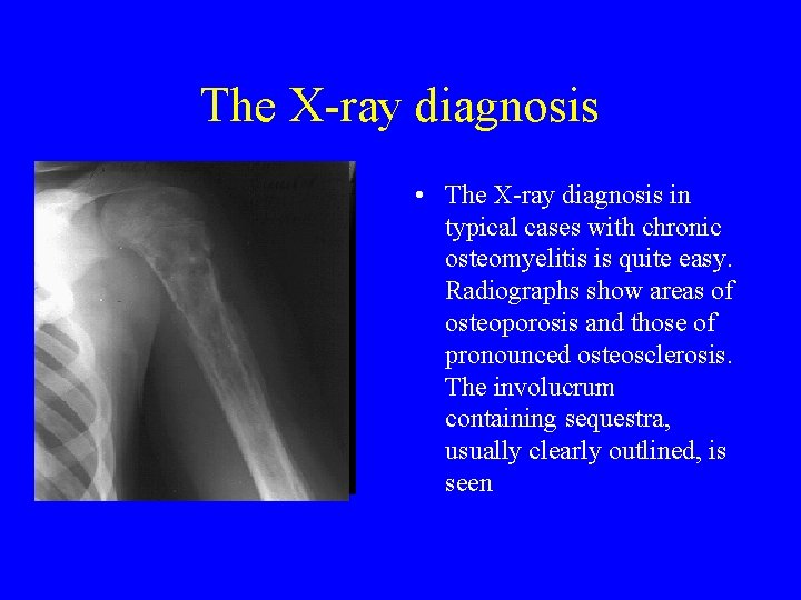 The X ray diagnosis • The X ray diagnosis in typical cases with chronic The X ray diagnosis • The X ray diagnosis in typical cases with chronic