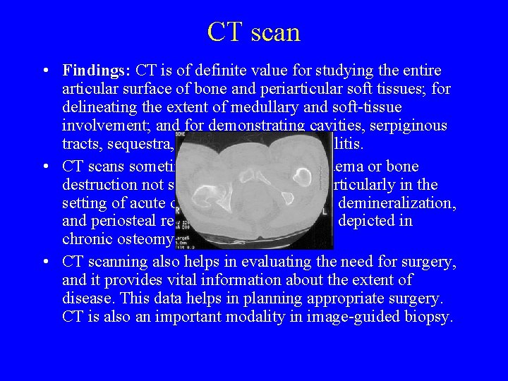 CT scan • Findings: CT is of definite value for studying the entire articular CT scan • Findings: CT is of definite value for studying the entire articular