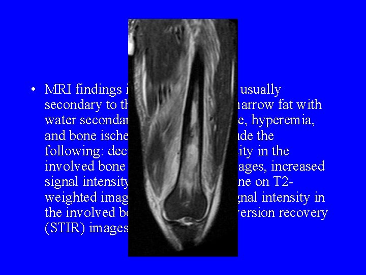MRI • MRI findings in osteomyelitis are usually secondary to the replacement of marrow MRI • MRI findings in osteomyelitis are usually secondary to the replacement of marrow