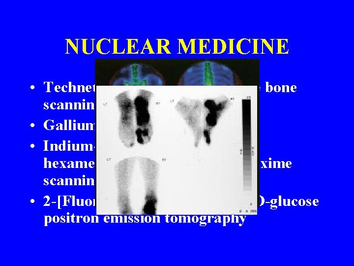 NUCLEAR MEDICINE • Technetium-99 m diphosphonate bone scanning • Gallium-67 scanning • Indium-111 WBC NUCLEAR MEDICINE • Technetium-99 m diphosphonate bone scanning • Gallium-67 scanning • Indium-111 WBC