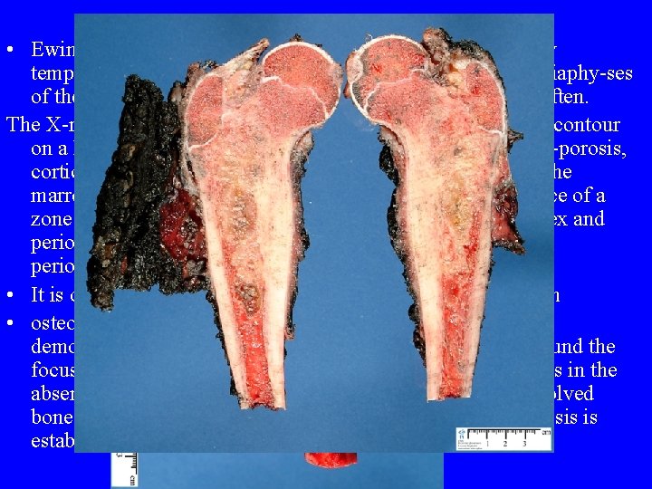 • Ewing's tumour (sarcoma) follows a wave like course. Body temperature rises and • Ewing's tumour (sarcoma) follows a wave like course. Body temperature rises and