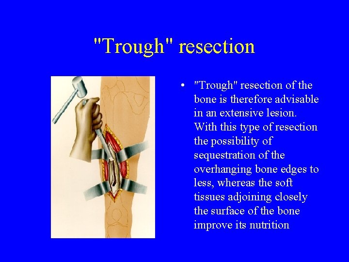 "Trough" resection • "Trough" resection of the bone is therefore advisable in an extensive "Trough" resection • "Trough" resection of the bone is therefore advisable in an extensive