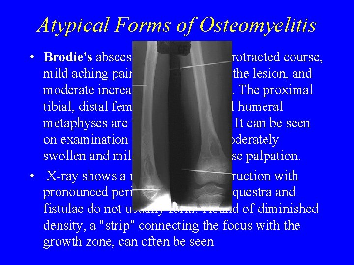Atypical Forms of Osteomyelitis • Brodie's abscess is marked by a protracted course, mild Atypical Forms of Osteomyelitis • Brodie's abscess is marked by a protracted course, mild