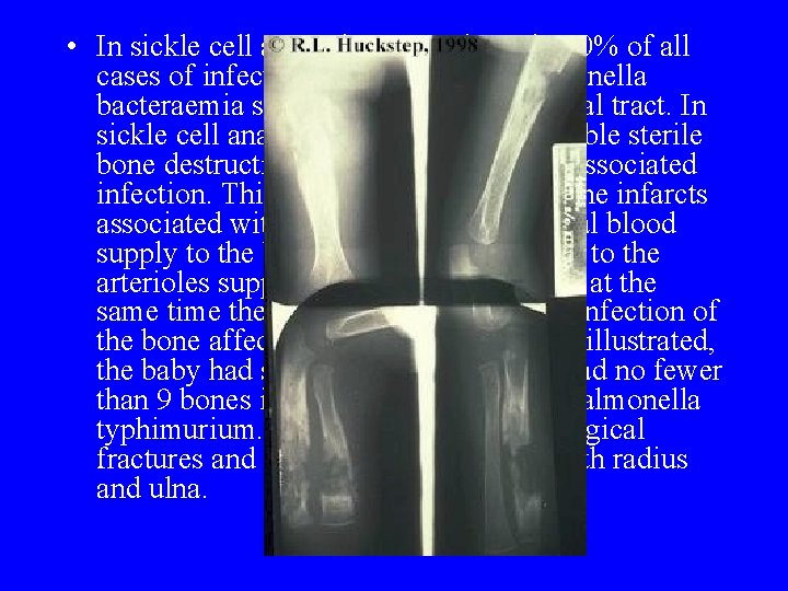 • In sickle cell anaemia, approximately 50% of all cases of infection are • In sickle cell anaemia, approximately 50% of all cases of infection are