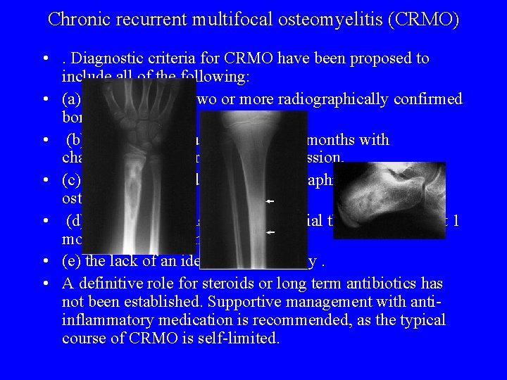 Chronic recurrent multifocal osteomyelitis (CRMO) • . Diagnostic criteria for CRMO have been proposed Chronic recurrent multifocal osteomyelitis (CRMO) • . Diagnostic criteria for CRMO have been proposed