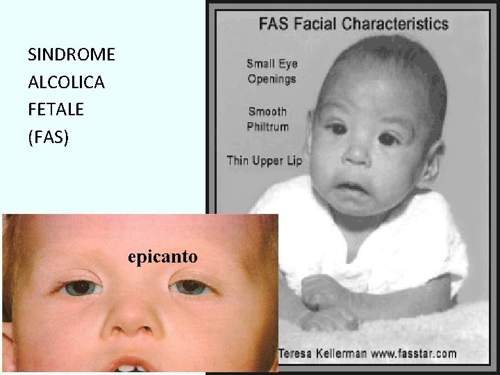 SINDROME ALCOLICA FETALE (FAS) epicanto SINDROME ALCOLICA FETALE (FAS) epicanto