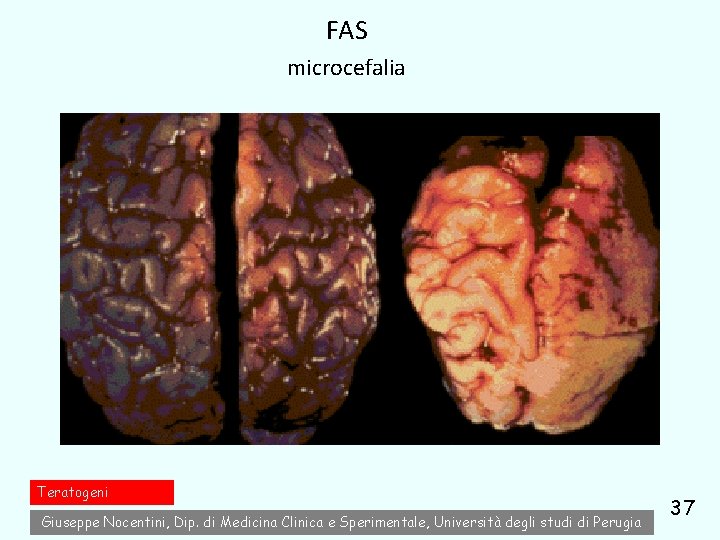 FAS microcefalia Teratogeni Giuseppe Nocentini, Dip. di Medicina Clinica e Sperimentale, Università degli studi FAS microcefalia Teratogeni Giuseppe Nocentini, Dip. di Medicina Clinica e Sperimentale, Università degli studi