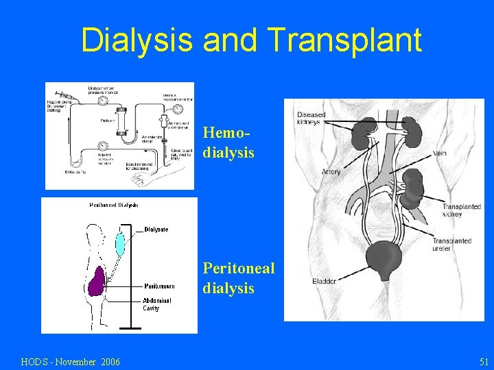 Dialysis and Transplant Hemodialysis Peritoneal dialysis HODS - November 2006 51 