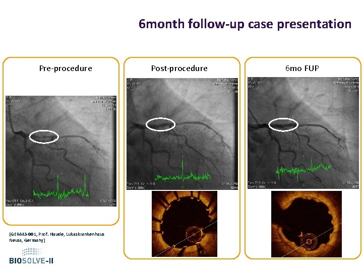 6 month follow-up case presentation Pre-procedure (GER 443 -001, Prof. Haude, Lukaskrankenhaus Neuss, Germany)