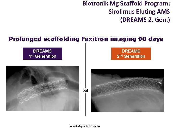 Biotronik Mg Scaffold Program: Sirolimus Eluting AMS (DREAMS 2. Gen. ) Prolonged scaffolding Faxitron