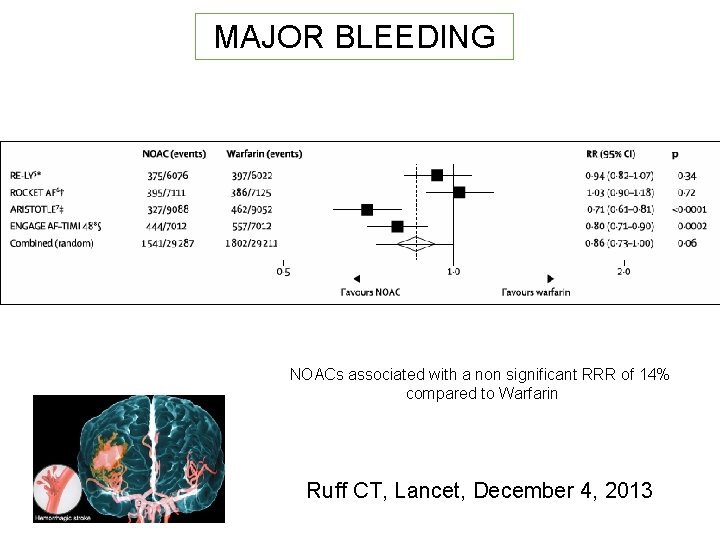 MAJOR BLEEDING NOACs associated with a non significant RRR of 14% compared to Warfarin
