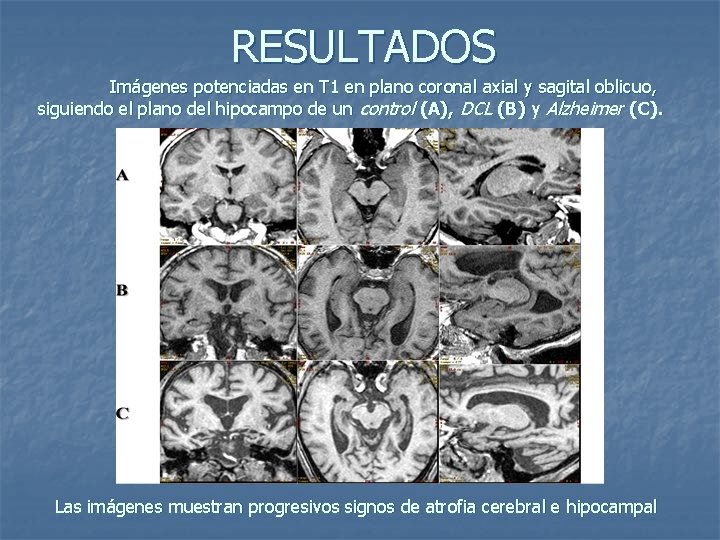 RESULTADOS Imágenes potenciadas en T 1 en plano coronal axial y sagital oblicuo, siguiendo