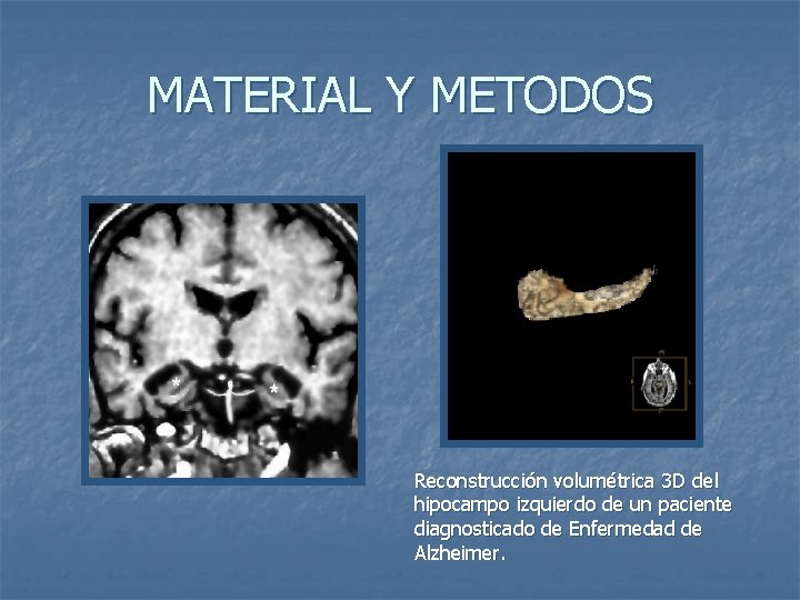 MATERIAL Y METODOS Reconstrucción volumétrica 3 D del hipocampo izquierdo de un paciente diagnosticado