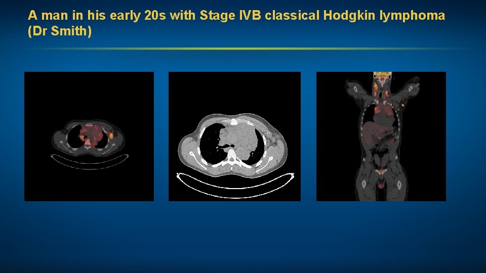 A man in his early 20 s with Stage IVB classical Hodgkin lymphoma (Dr