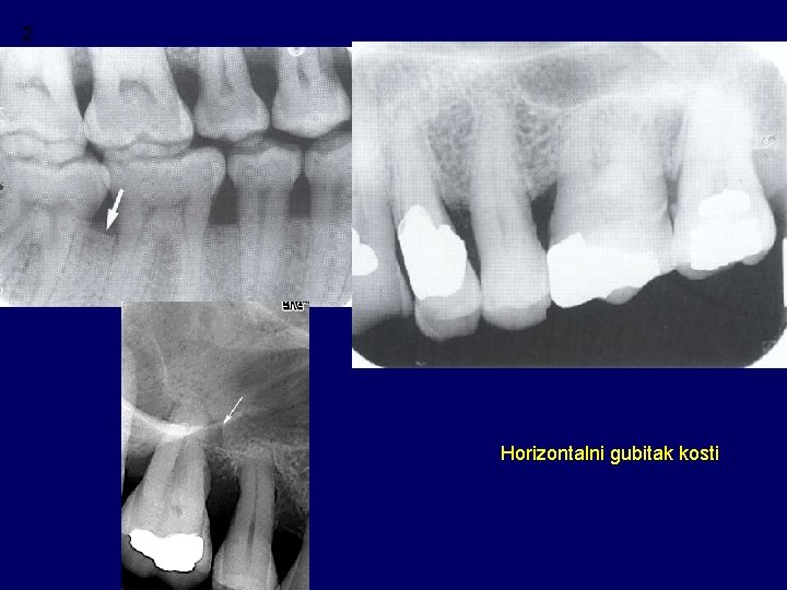 2 Horizontalni gubitak kosti 