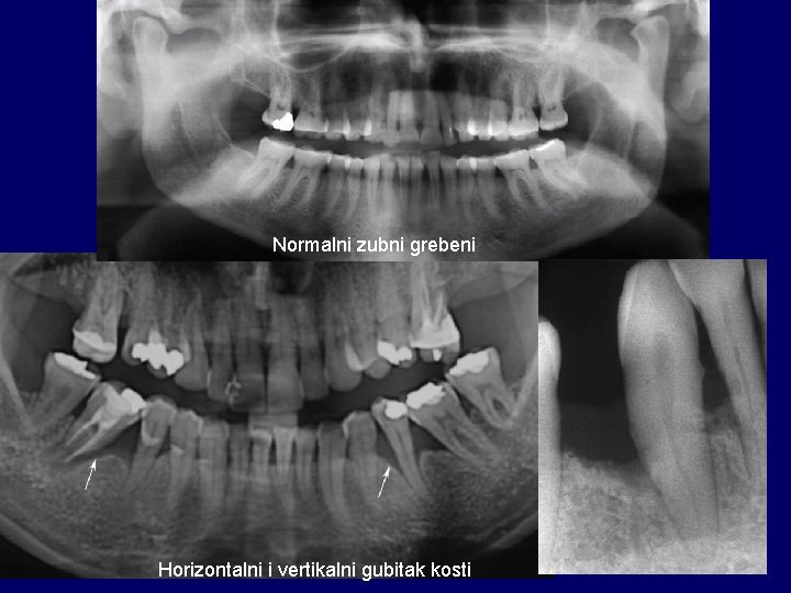 Normalni zubni grebeni Horizontalni i vertikalni gubitak kosti 