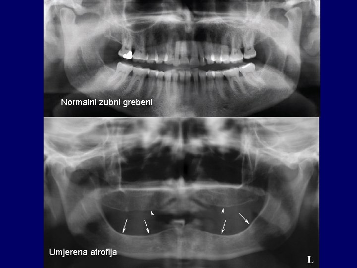 Normalni zubni grebeni Umjerena atrofija 