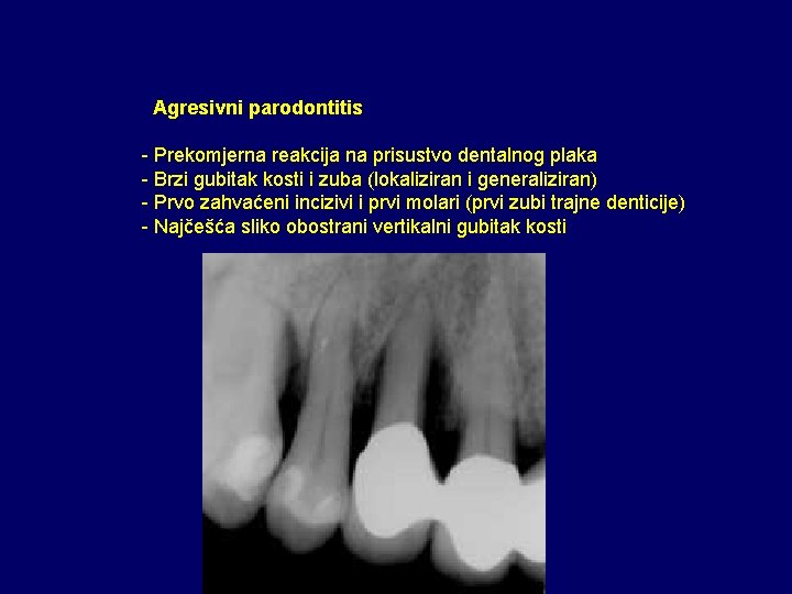 Agresivni parodontitis - Prekomjerna reakcija na prisustvo dentalnog plaka - Brzi gubitak kosti i Agresivni parodontitis - Prekomjerna reakcija na prisustvo dentalnog plaka - Brzi gubitak kosti i