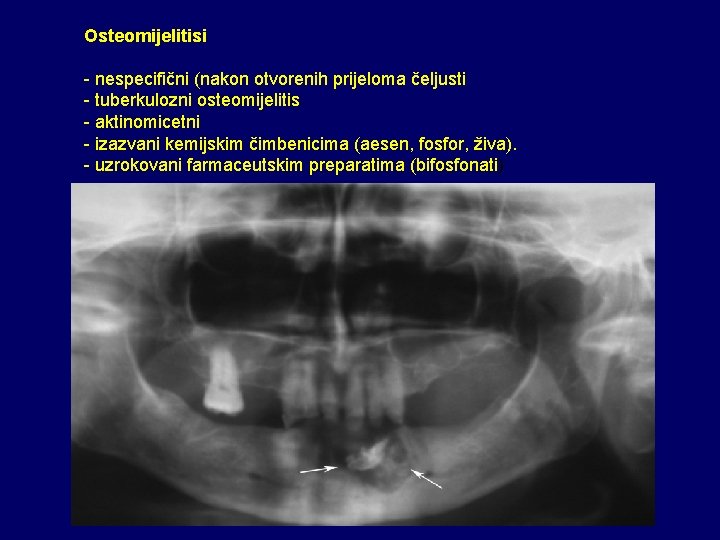 Osteomijelitisi - nespecifični (nakon otvorenih prijeloma čeljusti - tuberkulozni osteomijelitis - aktinomicetni - izazvani