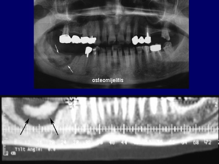osteomijelitis osteomijelitis