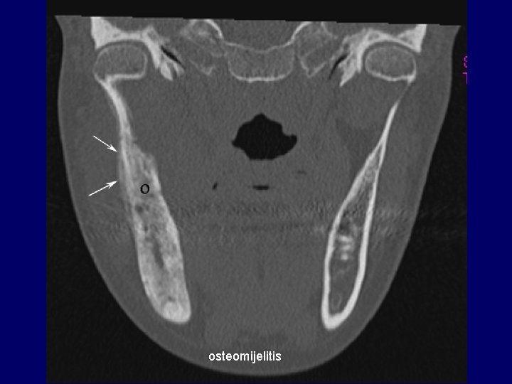 osteomijelitis 