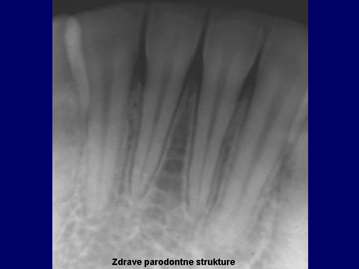 Zdrave parodontne strukture 