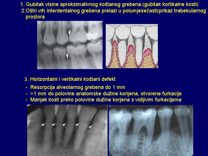 1. Gubitak visine aproksimativnog koštanog grebena. (gubitak kortikalne kosti) 2. Oštri vrh interdentalnog grebena