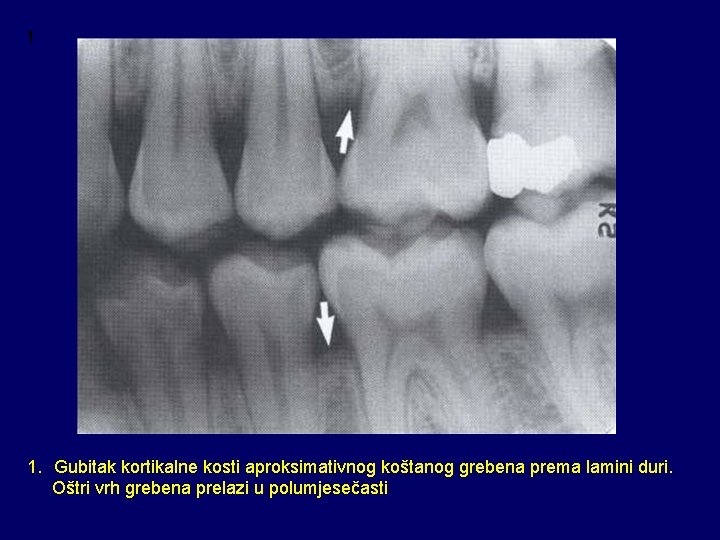 1 1. Gubitak kortikalne kosti aproksimativnog koštanog grebena prema lamini duri. Oštri vrh grebena