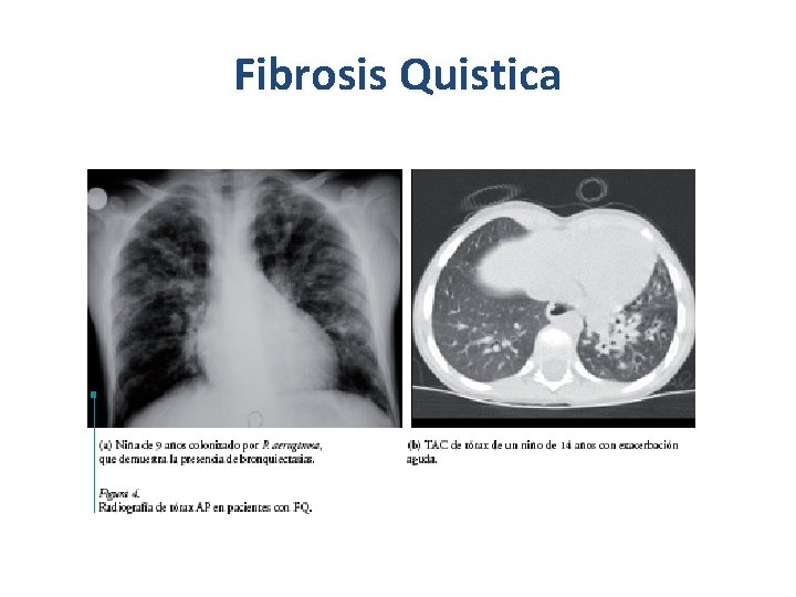 Fibrosis Quistica 