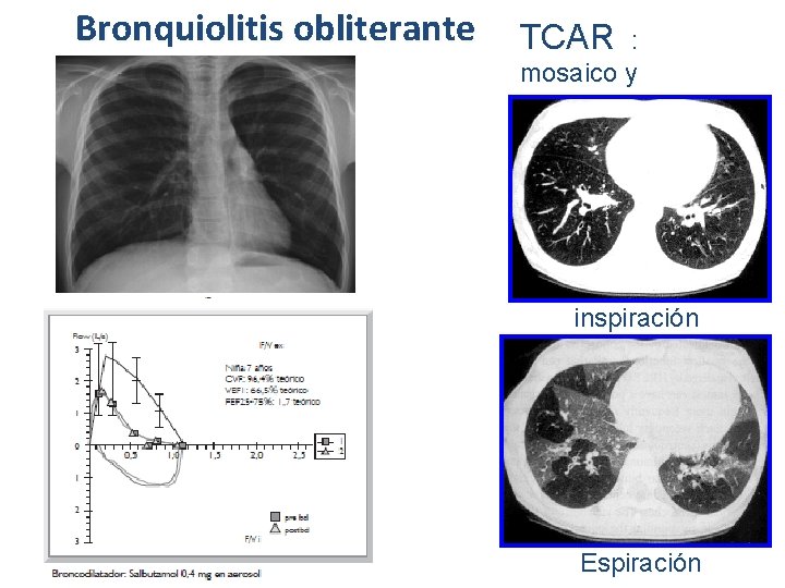 Bronquiolitis obliterante TCAR : mosaico y Atrapamiento aéreo inspiración Espiración 