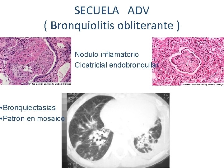 SECUELA ADV ( Bronquiolitis obliterante ) • Bronquiectasias • Patrón en mosaico Nodulo inflamatorio