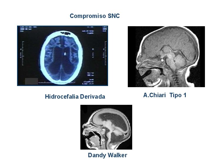 Compromiso SNC Hidrocefalia Derivada Dandy Walker A. Chiari Tipo 1 