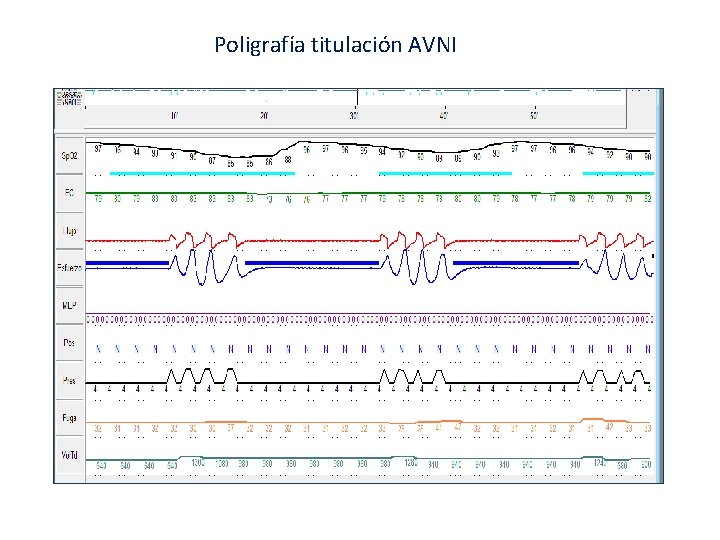 Poligrafía titulación AVNI 