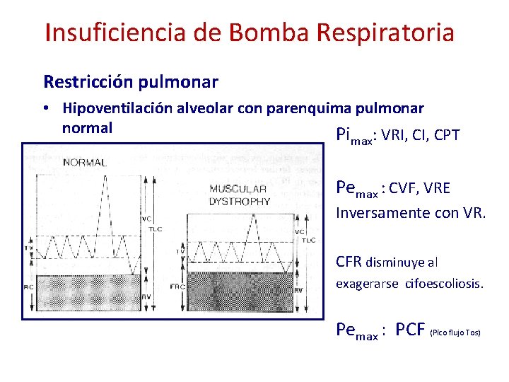 Insuficiencia de Bomba Respiratoria Restricción pulmonar • Hipoventilación alveolar con parenquima pulmonar normal Pi