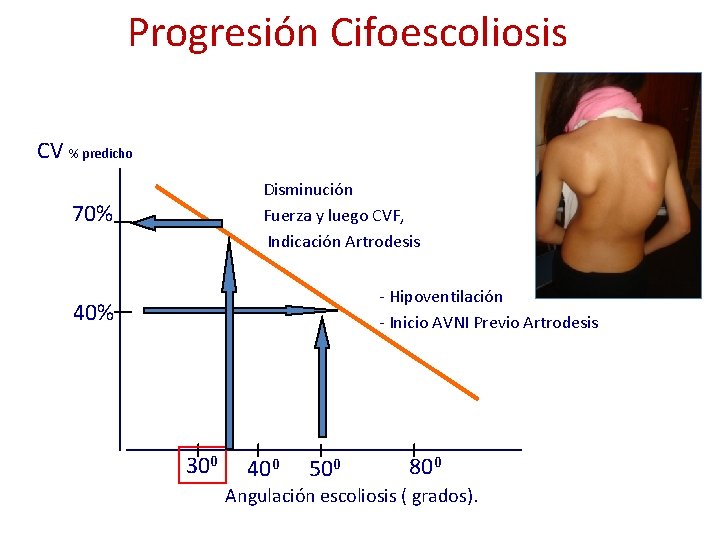 Progresión Cifoescoliosis CV % predicho Disminución Fuerza y luego CVF, Indicación Artrodesis 70% -