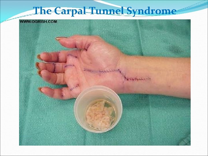 The Carpal Tunnel Syndrome 