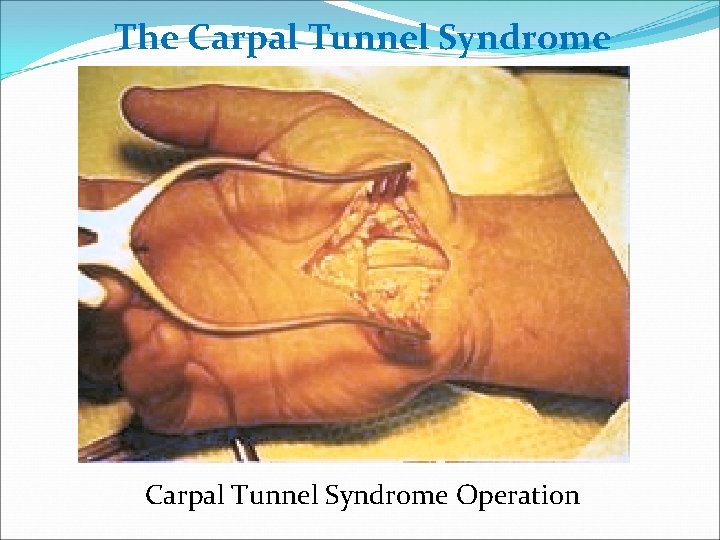 The Carpal Tunnel Syndrome Operation 