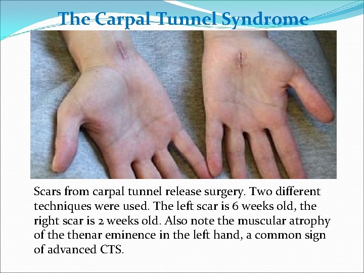The Carpal Tunnel Syndrome Scars from carpal tunnel release surgery. Two different techniques were