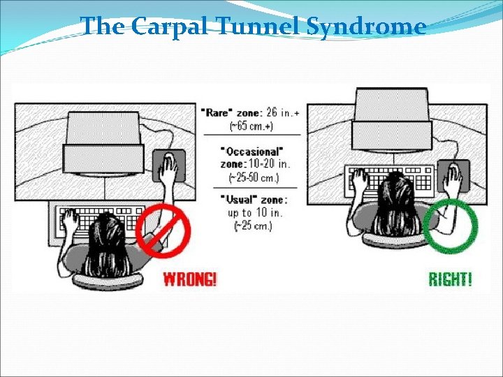 The Carpal Tunnel Syndrome 