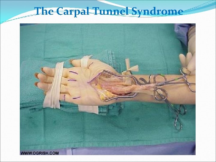 The Carpal Tunnel Syndrome 