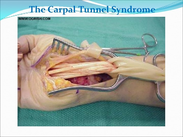 The Carpal Tunnel Syndrome 