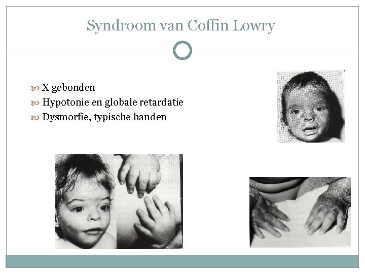 Syndroom van Coffin Lowry X gebonden Hypotonie en globale retardatie Dysmorfie, typische handen Syndroom van Coffin Lowry X gebonden Hypotonie en globale retardatie Dysmorfie, typische handen