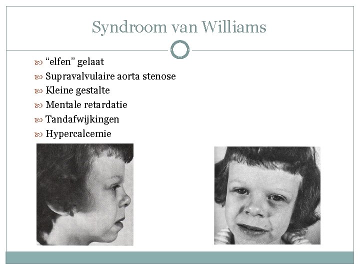Syndroom van Williams “elfen” gelaat Supravalvulaire aorta stenose Kleine gestalte Mentale retardatie Tandafwijkingen Hypercalcemie Syndroom van Williams “elfen” gelaat Supravalvulaire aorta stenose Kleine gestalte Mentale retardatie Tandafwijkingen Hypercalcemie
