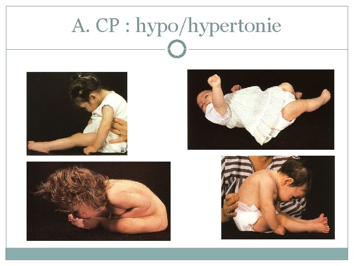 A. CP : hypo/hypertonie A. CP : hypo/hypertonie