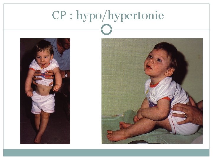 CP : hypo/hypertonie CP : hypo/hypertonie