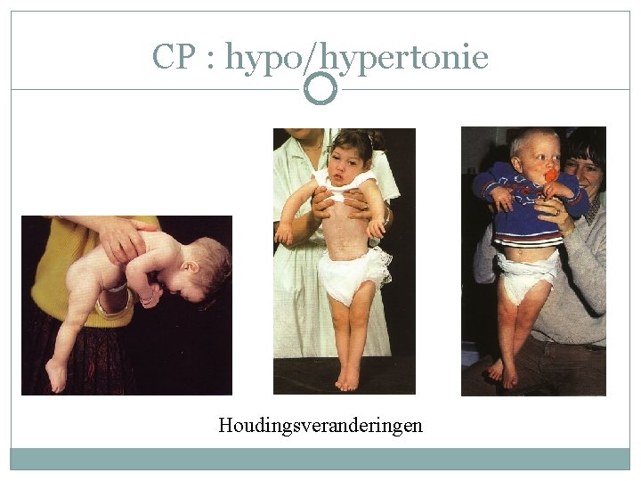 CP : hypo/hypertonie Houdingsveranderingen CP : hypo/hypertonie Houdingsveranderingen