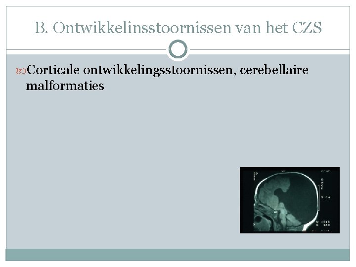 B. Ontwikkelinsstoornissen van het CZS Corticale ontwikkelingsstoornissen, cerebellaire malformaties B. Ontwikkelinsstoornissen van het CZS Corticale ontwikkelingsstoornissen, cerebellaire malformaties