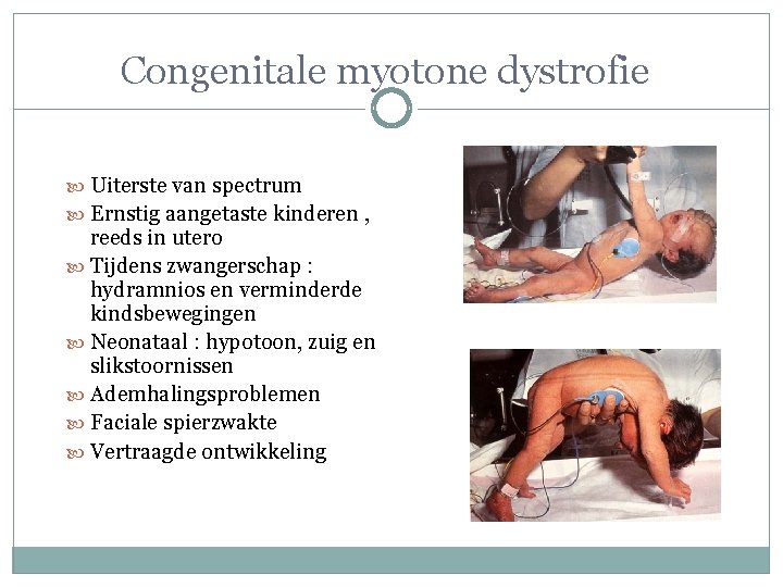 Congenitale myotone dystrofie Uiterste van spectrum Ernstig aangetaste kinderen , reeds in utero Tijdens Congenitale myotone dystrofie Uiterste van spectrum Ernstig aangetaste kinderen , reeds in utero Tijdens
