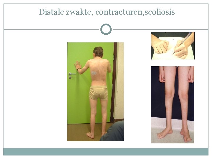 Distale zwakte, contracturen, scoliosis Distale zwakte, contracturen, scoliosis