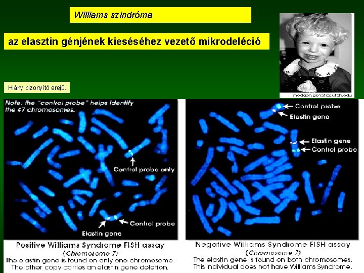 Williams szindróma az elasztin génjének kieséséhez vezető mikrodeléció Hiány bizonyító erejű. 